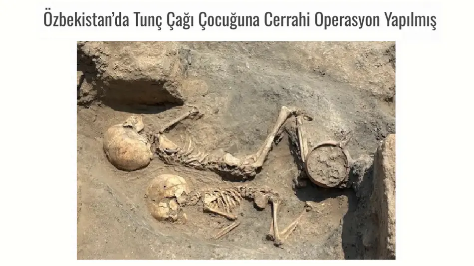 O‘zbekiston hududidan bronza davriga oid jarrohlik amaliyoti izlari topildi
